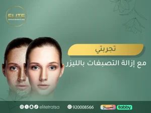 تجربتي مع إزالة التصبغات بالليزر: وتعليمات قبل وبعد جلسات علاج التصبغات