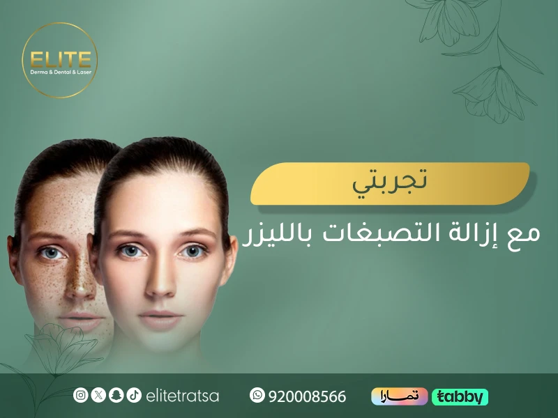 تجربتي مع إزالة التصبغات بالليزر: وتعليمات قبل وبعد جلسات علاج التصبغات