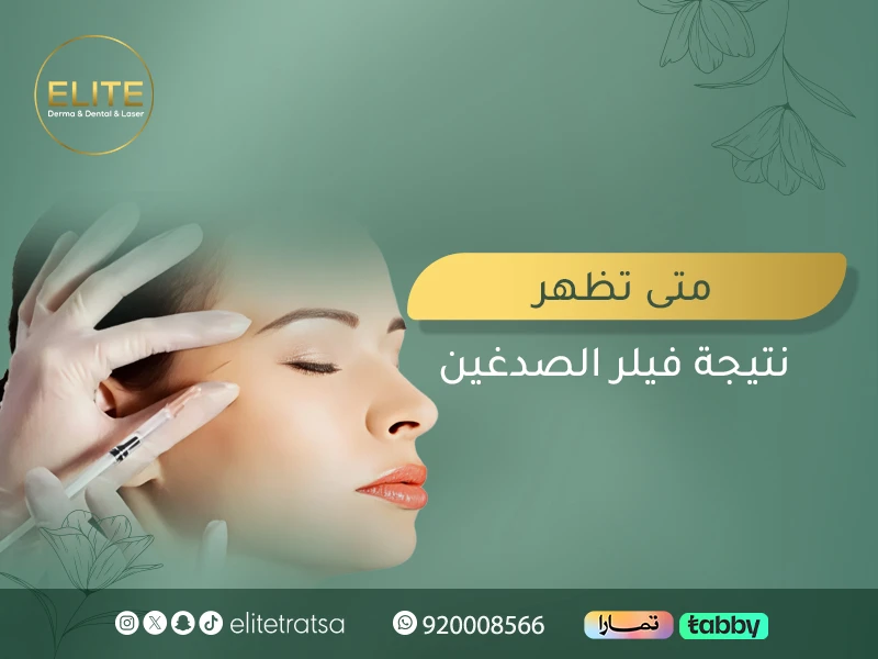 متى تظهر نتيجة فيلر الصدغين؟ تجربتي واسرار فيلر الاصداغ لتحسين ملامح الوجه