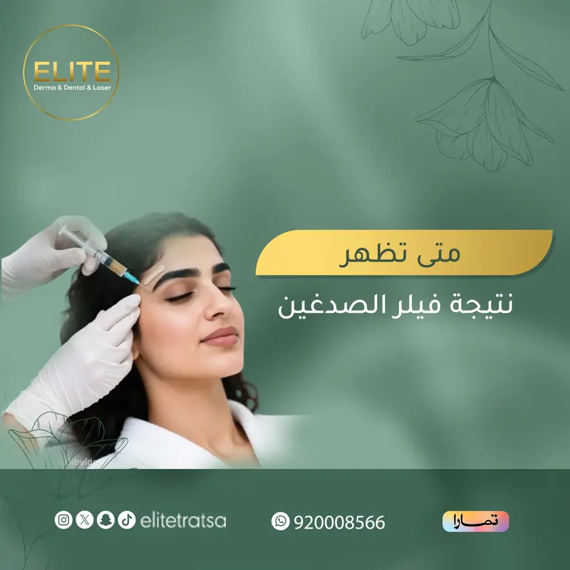 تجربتي مع فيلر الصدغين