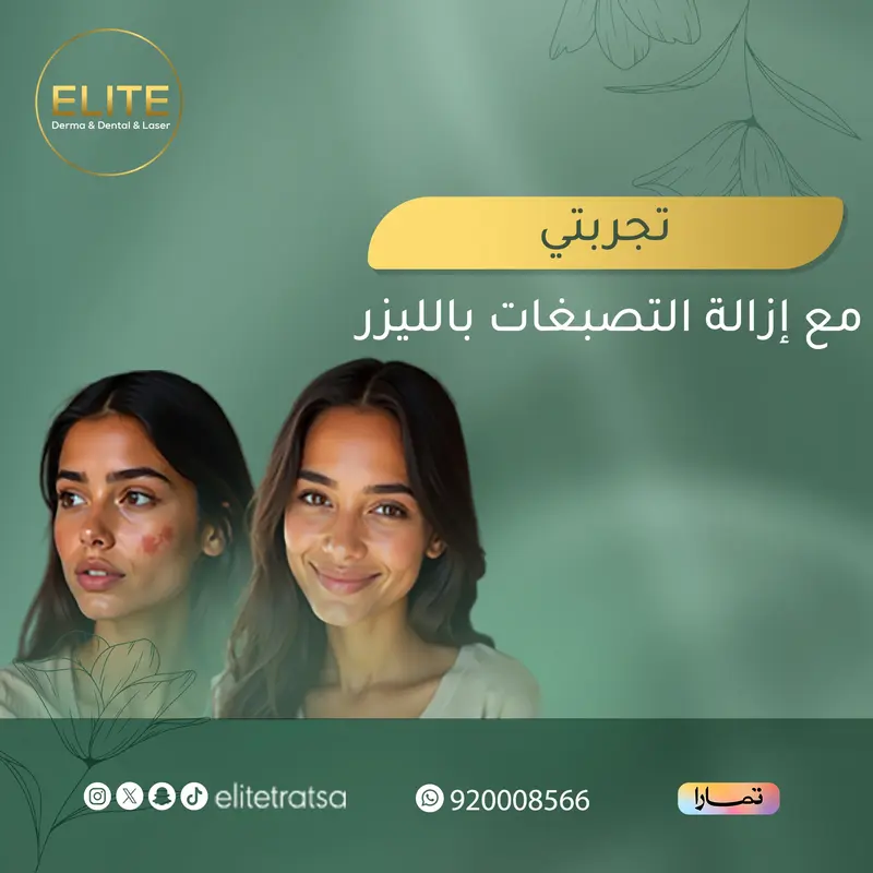 تجربتي مع إزالة التصبغات بالليزر