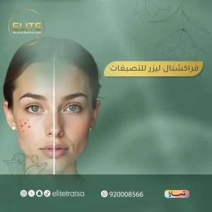 فراكشنال ليزر للتصبغات: اسرار تجربتي مع ليزر الفراكشنال للتصبغات