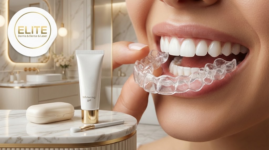 قوالب التبييض المنزلي للأسنان 