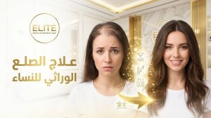 علاج الصلع الوراثي للنساء مع عيادات النخبة