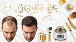 علاج الصلع الوراثي للنساء والرجال مع عيادات النخبة