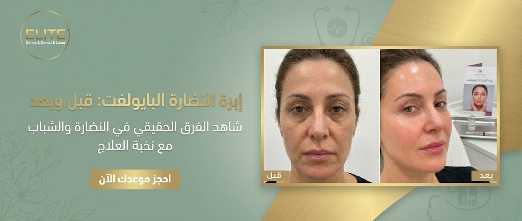 إبرة النضارة البايولفت قبل وبعد: هل الفرق واضح فعلاً؟