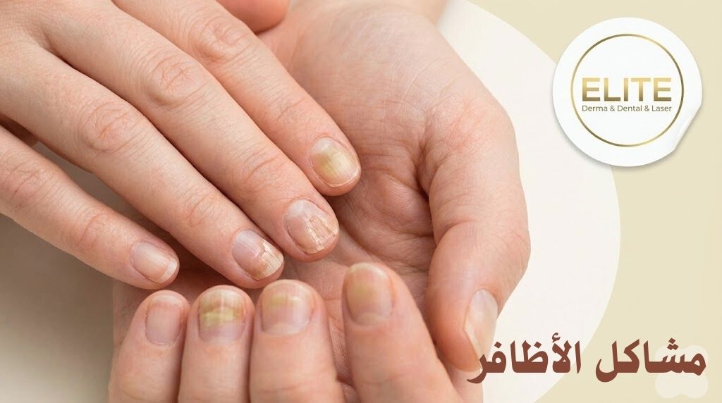 مشاكل الجلد حول الأظافر: التشققات، الالتهابات، والزوائد