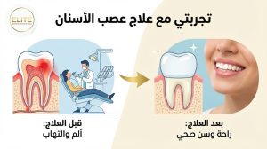 تجربتي مع علاج عصب الأسنان