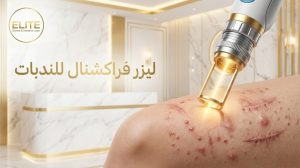 ليزر فراكشنال للندبات