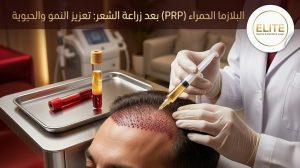 البلازما الحمراء بعد زراعة الشعر