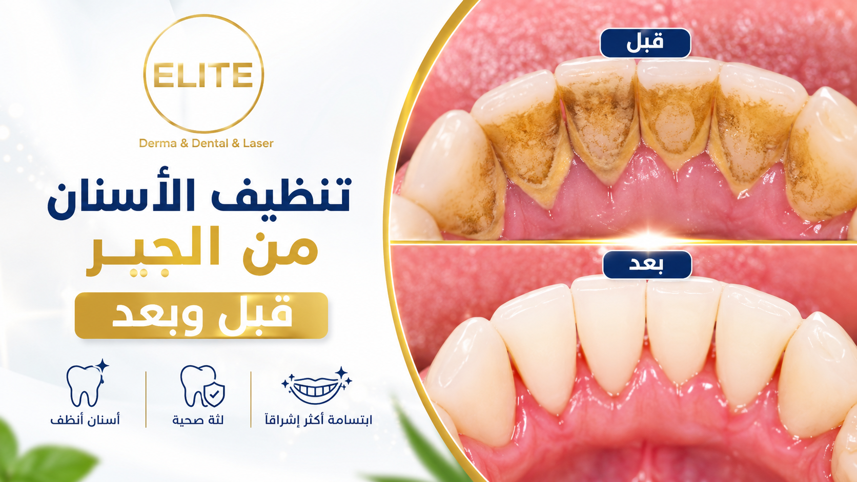 تنظيف الأسنان من الجير قبل وبعد