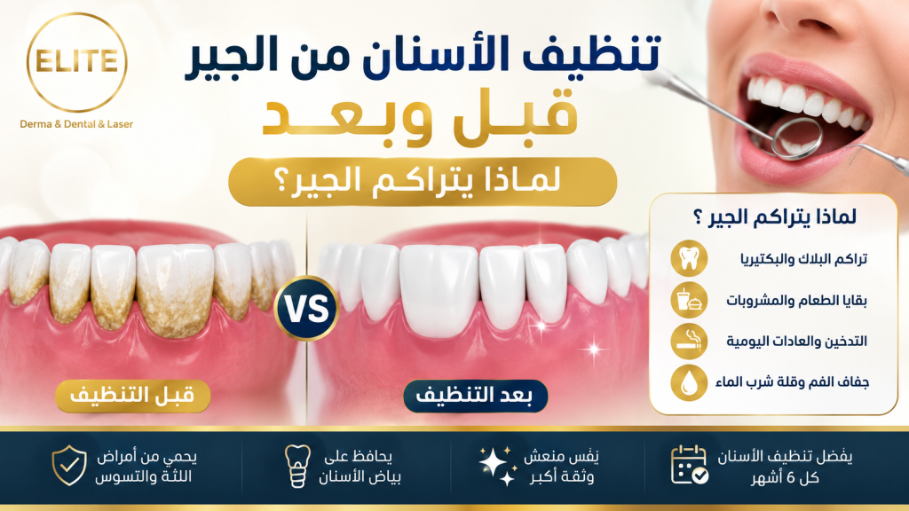 تنظيف الاسنان من الجير قبل وبعد: لماذا يتراكم الجير؟