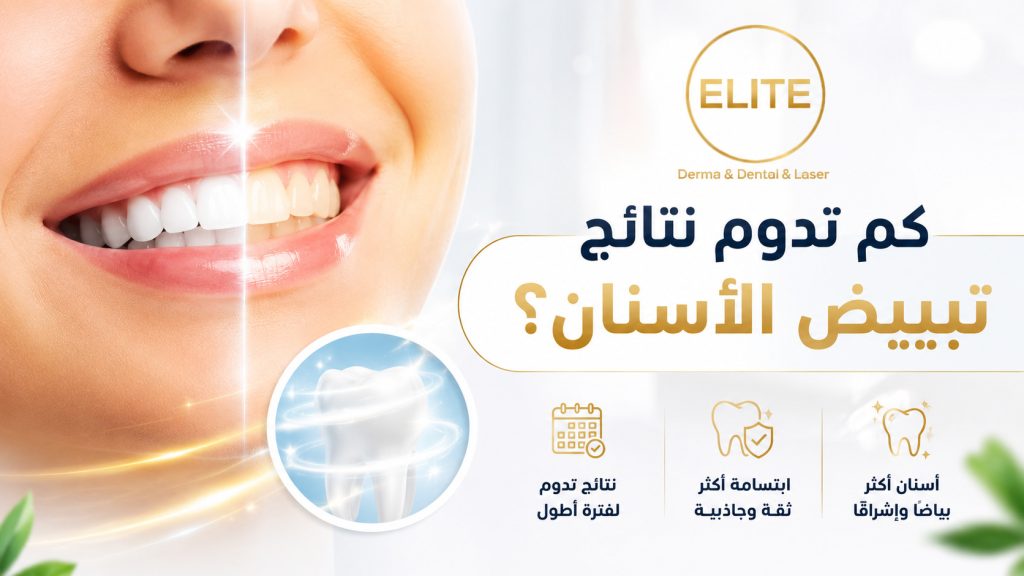 كم تدوم نتائج تبييض الأسنان؟