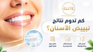 كم تدوم نتائج تبييض الأسنان؟