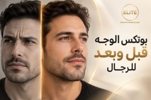 بوتكس الوجه قبل وبعد للرجال