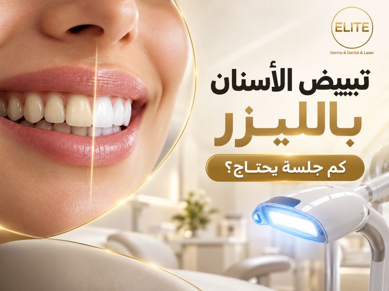 تبييض الأسنان بالليزر كم جلسة يحتاج