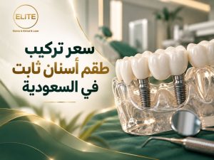 سعر تركيب طقم أسنان ثابت في السعودية