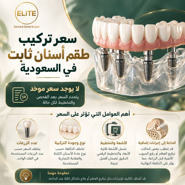ما هو سعر تركيب طقم أسنان ثابت في السعودية